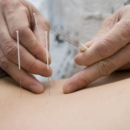 Dry-needling-Prime-Physical-Therapy-Plains-PA