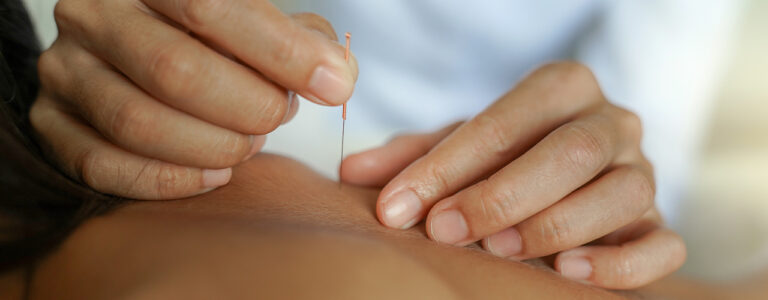 Dry-needling-Prime-Physical-Therapy-Plains-PA