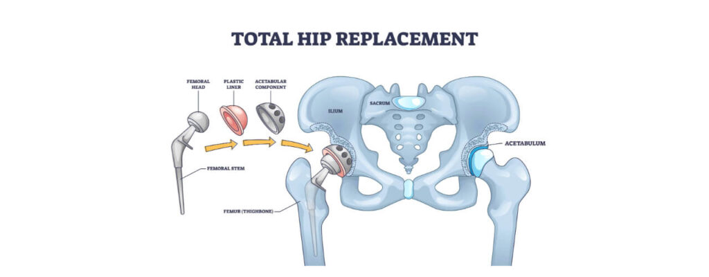 Hip Replacement Rehab: Steps to a Full Recovery